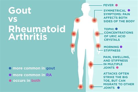 rematoid artrit gut artrit